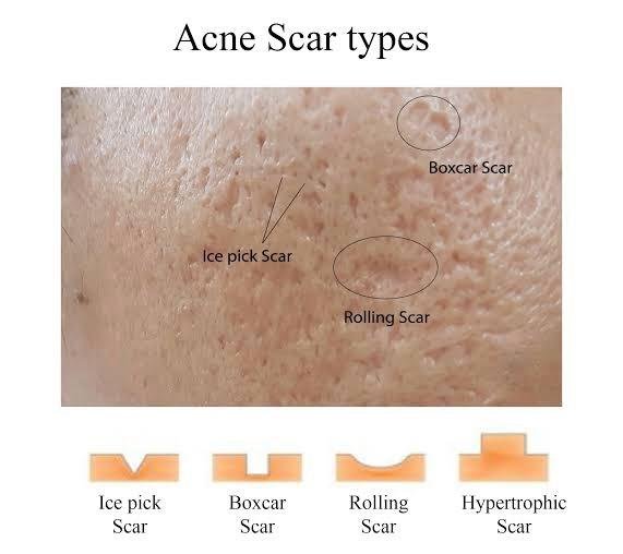 Chart of the four acne scar types: ice pick, boxcar, rolling and hypertrophic