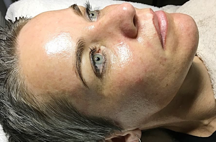 A client's face before dermaplaning, and brighter, glowing skin after