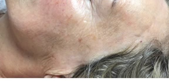 Crepey, lined skin on the temple before dermaplaning, and smoother skin after