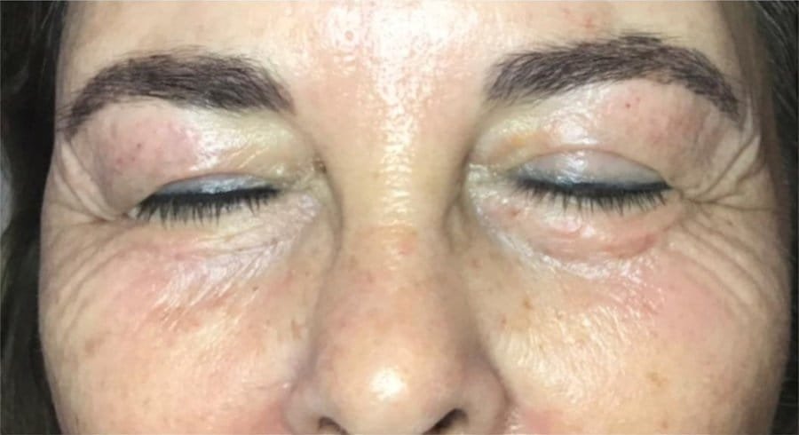 Crow's feet around closed eyes before Plasma Corrective Pen, and after