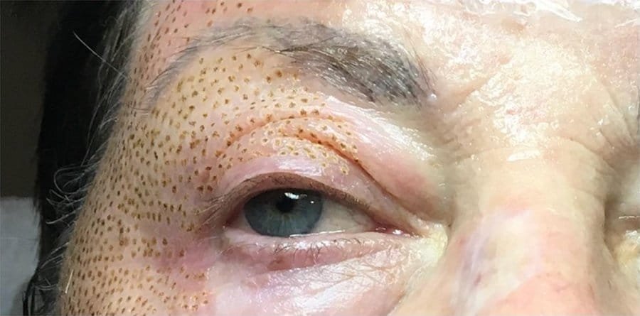 A hooded eyelid before, and straight after a Plasma Corrective Pen session