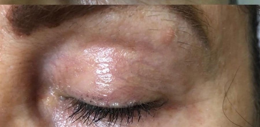 A crepey upper eyelid before Plasma Corrective Pen, and a smoother eyelid after one session