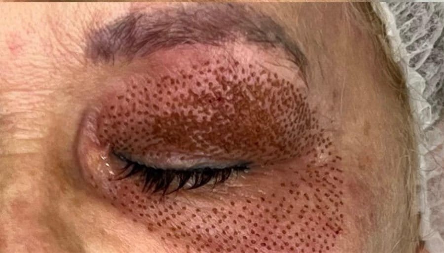 An upper eyelid before, and straight after Plasma Corrective Pen