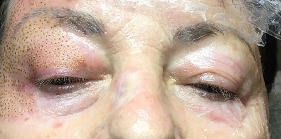 Both eyelids before, and one eyelid straight after a Plasma Corrective Pen session