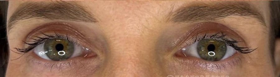 Eyes open before, straight after and healed from Plasma Corrective Pen, with more visible eyelids
