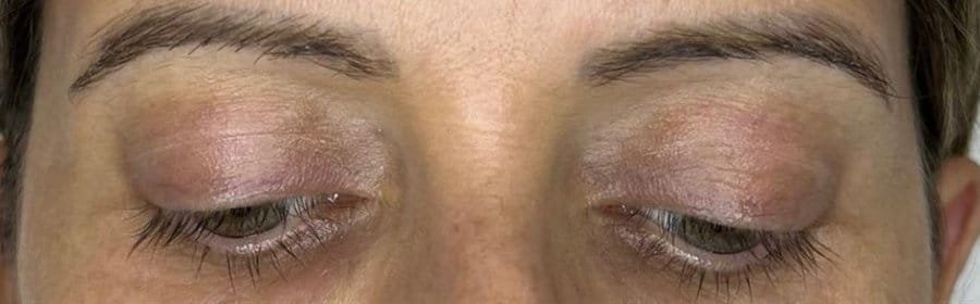 Upper eyelids before, straight after and healed from one Plasma Corrective Pen session, with less skin over the lash line