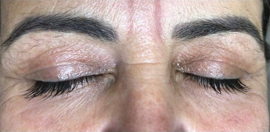 Heavy hooded eyelids before Plasma Corrective Pen, and lifted eyelids after