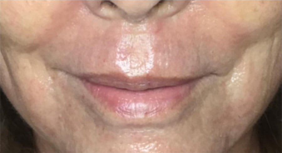 Fine lines around the lips before Plasma Corrective Pen, and softer lines after