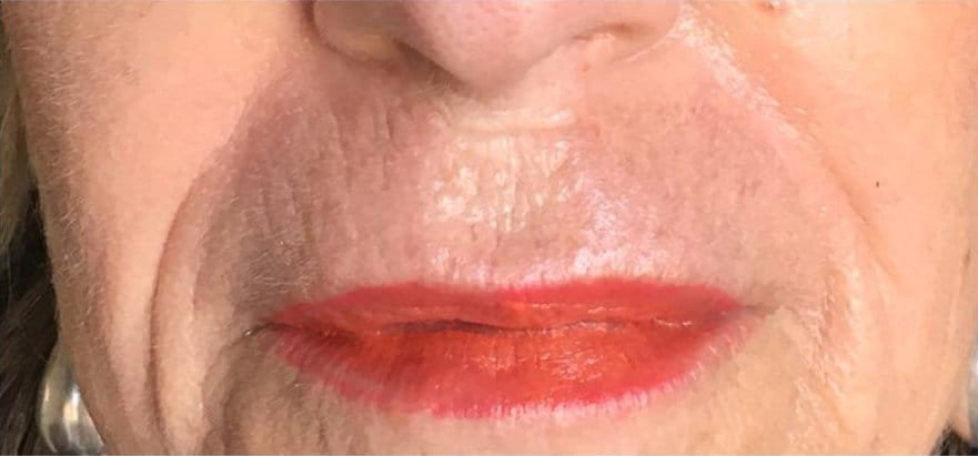 Lip lines before, straight after and healed from one Plasma Corrective Pen session