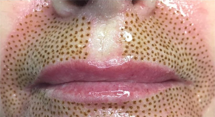 Lip lines before, and straight after Plasma Corrective Pen
