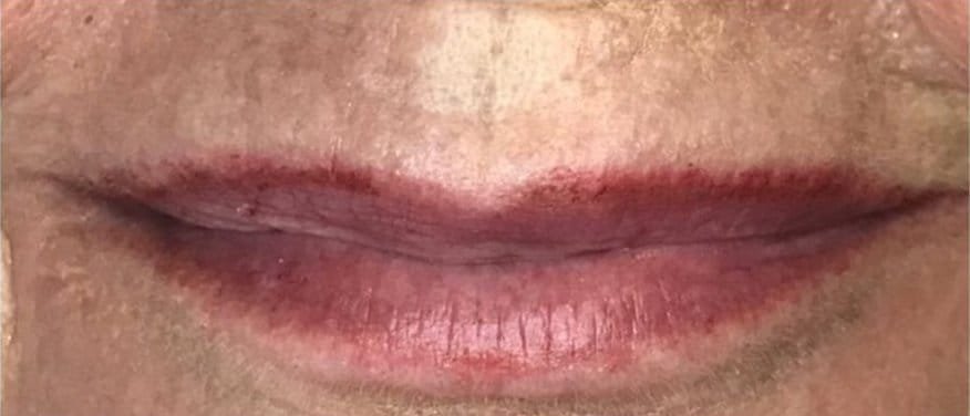 Deep lip lines before, straight after and healed from Plasma Corrective Pen