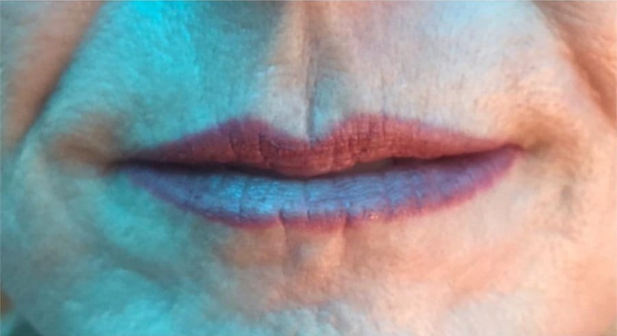 Lip lines before Plasma Corrective Pen, and the area prepared for treatment