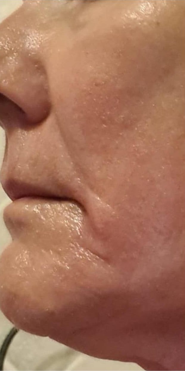 Lines around the mouth and jowl in profile before Plasma Corrective Pen, and smoother skin after