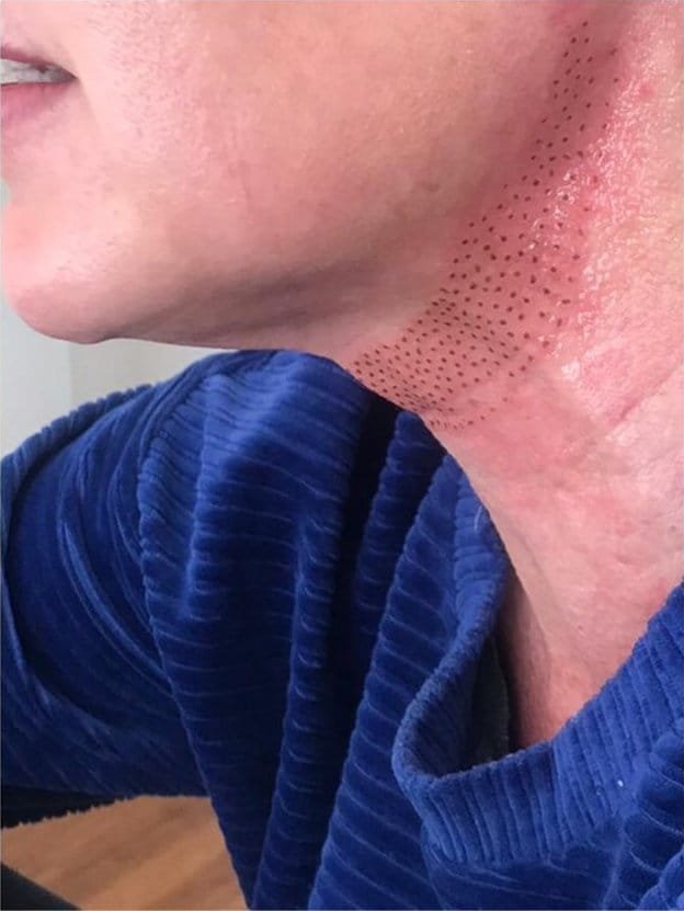 Loose skin on the neck before Plasma Corrective Pen, and the neck healing after treatment