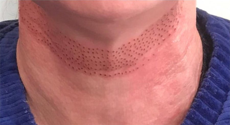 Neck lines before, and straight after Plasma Corrective Pen