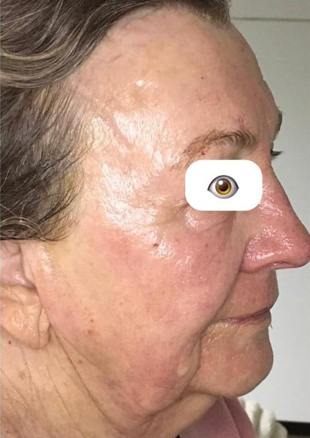 A client in profile before Plasma Corrective Pen, and with firmer skin on the face and neck after