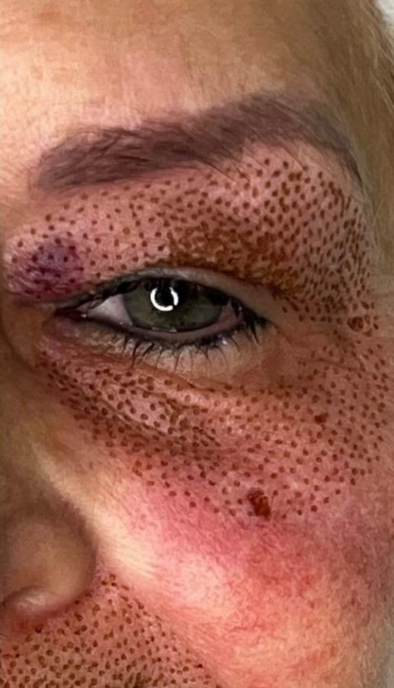 The under-eye area before, and straight after Plasma Corrective Pen
