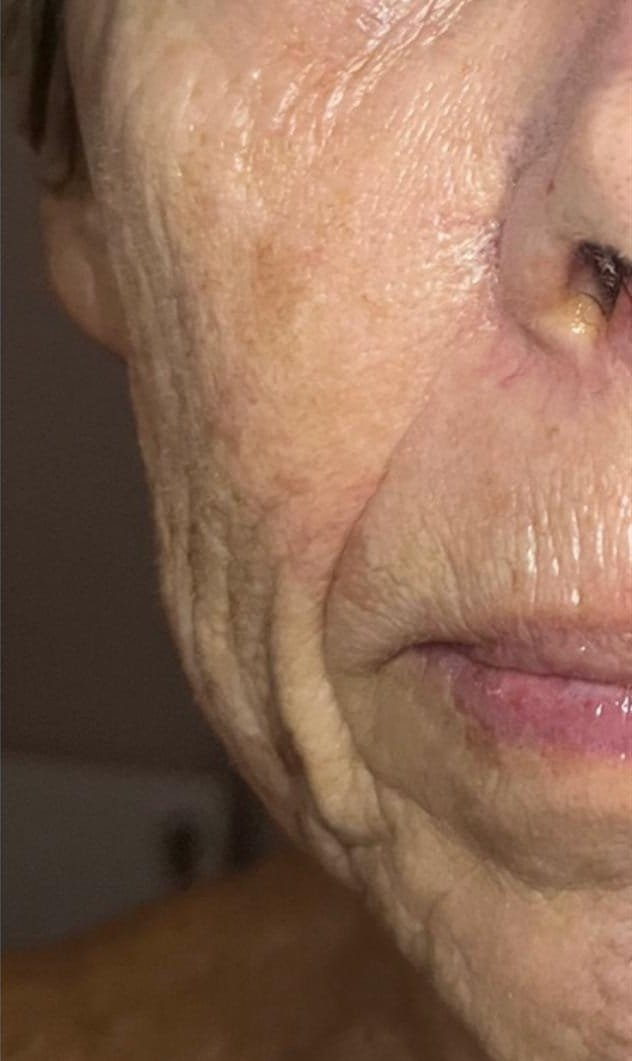Deep creases beside the mouth before Plasma Express, and softer creases after