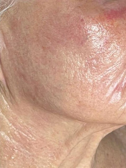 Crepey skin along the cheek and jaw before Plasma Express, and firmer skin after three sessions