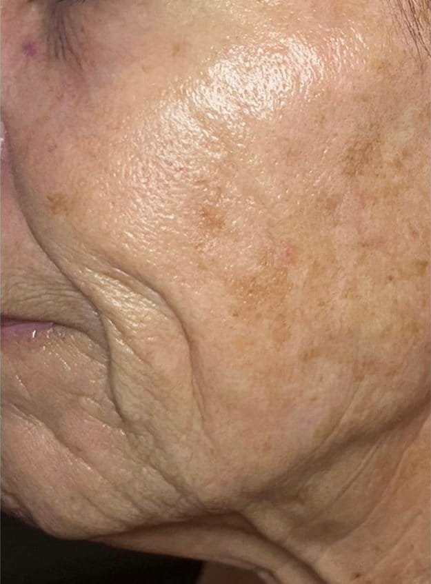 Deep lines across the cheek before Plasma Express, and visibly smoother skin after three sessions