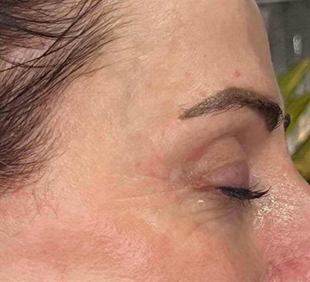 Crow's feet in profile before Plasma Express, and smoother skin around the eye after three sessions