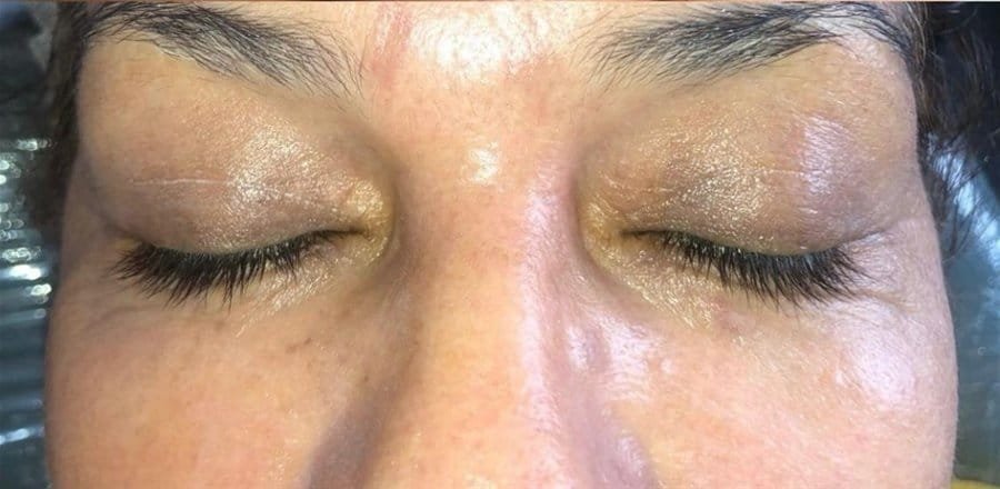 Frown lines and eyelids before Plasma Express, and a smoother brow area after three sessions