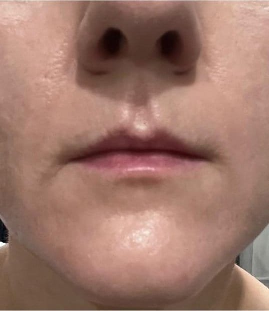 Uneven texture on the lower face before Plasma Express, and clearer skin after three sessions