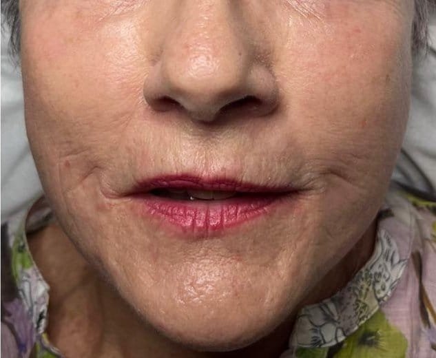 Lines around the mouth and chin before Plasma Express, and a smoother lower face after