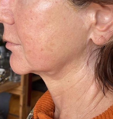 Scarring along the jaw and neck, mapped out before Plasma Express, and faded after three sessions