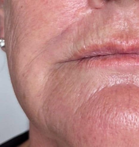 Scarring above the lip before Plasma Express scar repair, and smoother skin after three sessions