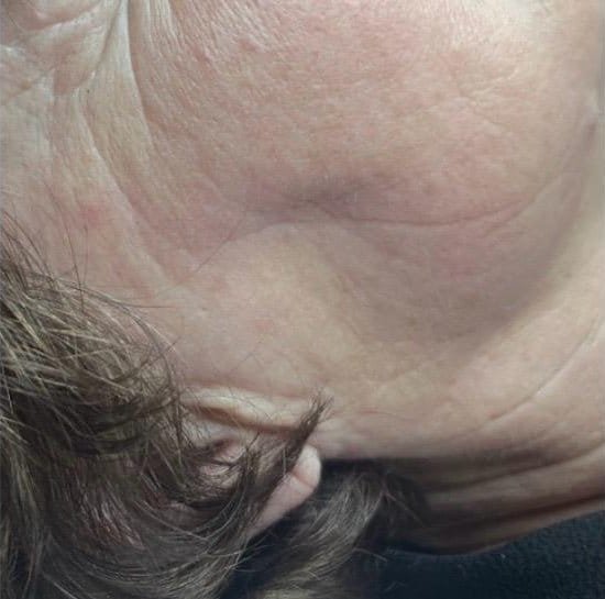 Loose skin under the chin before Plasma Express, and tighter skin after three sessions
