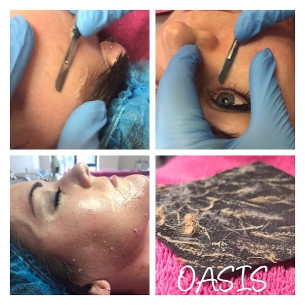 Dermaplaning at Oasis: the blade held against the forehead and brow, smooth skin afterwards, and the dead skin and peach fuzz removed