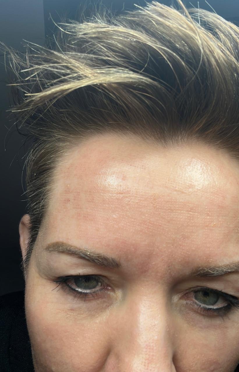 A client's forehead and face straight after a Plasma Express treatment, with only light redness