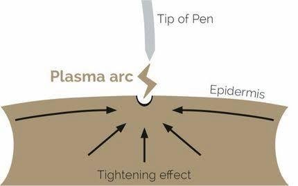 Diagram: a plasma arc forms between the tip of the pen and the epidermis, and the surrounding skin draws in with a tightening effect