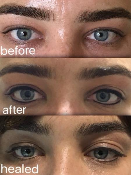 Eyes before permanent eyeliner, straight after, and healed with a soft defined line
